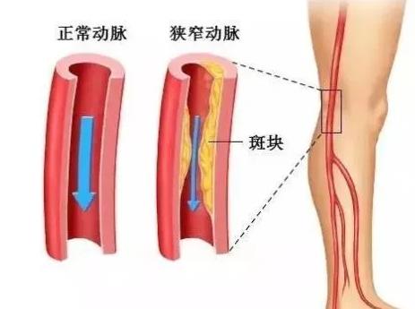 无创动脉硬化检测你做过吗？